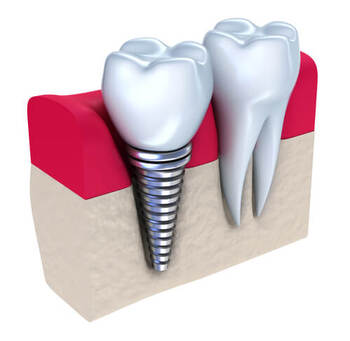 dental implants cost image