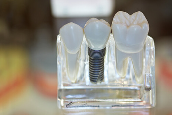 are dental implants painful image