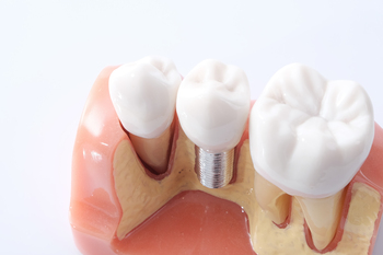 
dental implant value sydney